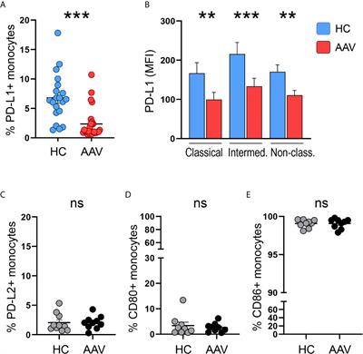 CMTM6-Deficient Monocytes in ANCA-Associated Vasculitis Fail to Present the Immune Checkpoint PD-L1